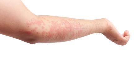 Impetigo je odborné označení pro infekční kožní nemoc způsobovaná bakteriemi.